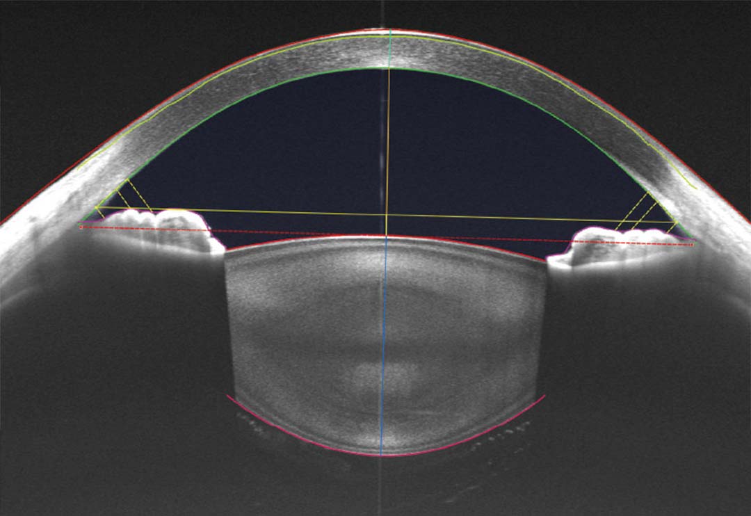 TowardPi-Yalkaid-100KHz-4int