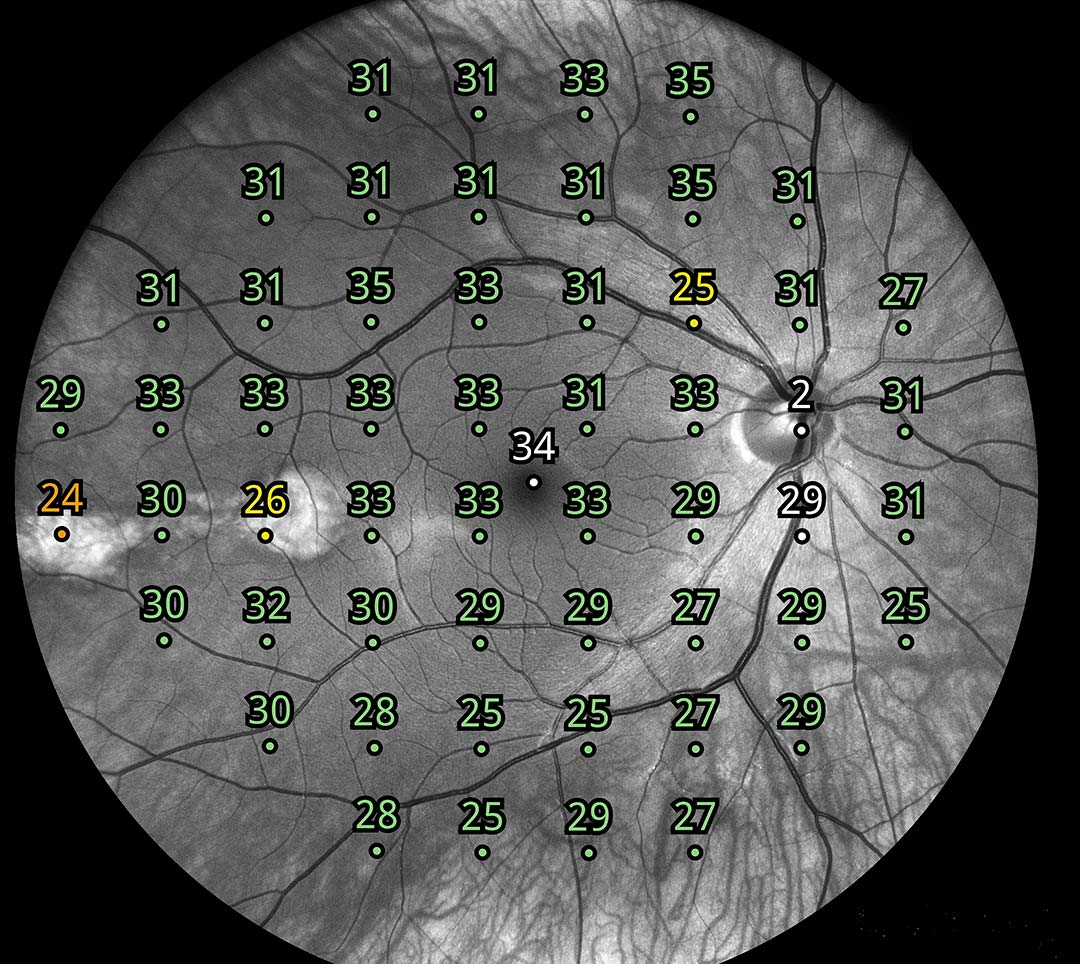 iCare-COMPASS-2int